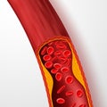 Blocked blood vessel, artery with cholesterol thrombus. 3d vein with clot vector illustration