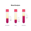 Blood analysis infographic. Vector flat healthcare illustration. Blood sample of normal, anemia and polycythemia. Design for