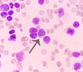 Blood cancer. Acute Myeloblastic Leukemia or AML. Royalty Free Stock Photo