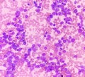 Blood cancer. Photomicrograph of Acute Myeloblastic Leukemia or AML, a cancer of white blood cell. Royalty Free Stock Photo