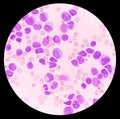 Blood cancer. Acute Myeloblastic Leukemia or AML. Royalty Free Stock Photo