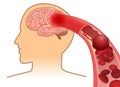 Blood cell can`t flow into human brain because clogged arteries by blood clot. Royalty Free Stock Photo