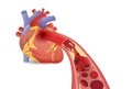 Blood cell can`t flow into human heart because clogged arteries by fatty.