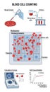 Blood cell counting process illustrated in multiple steps. At the top, a pipette draws a sample Royalty Free Stock Photo