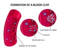 Blood Cells Thrombus Infographics