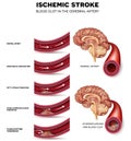 Blood clot formation in the cerebral artery