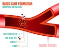 Blood clot formation Royalty Free Stock Photo