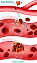 Blood clot formation Royalty Free Stock Photo