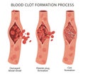 Blood clot formation, or hemostasis Royalty Free Stock Photo