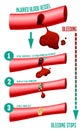 Blood clot formation