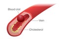 Blood clot occurs in a vein.