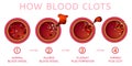 Blood clotting process Royalty Free Stock Photo