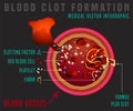 Blood clotting process Royalty Free Stock Photo