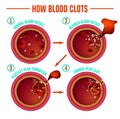 Blood clotting process Royalty Free Stock Photo