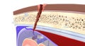 If head trauma occurs, increased stress on the bridging veins can cause them to tear. This leads to subdural bleeding