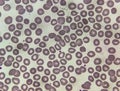 Blood film microscopic show decrease platelets leucocyte (WBC).