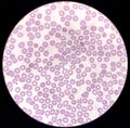 Blood film microscopic show decrease platelets leucocyte (WBC). Royalty Free Stock Photo