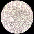 Blood film microscopic show decrease platelets leucocyte (WBC). Royalty Free Stock Photo