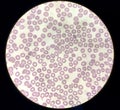 Blood film microscopic show decrease platelets leucocyte (WBC). Royalty Free Stock Photo