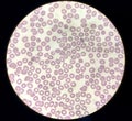 Blood film microscopic show decrease platelets leucocyte (WBC).