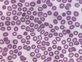 Blood film microscopic show decrease platelets leucocyte (WBC). Royalty Free Stock Photo