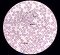 Blood film microscopic show decrease platelets leucocyte (WBC). Royalty Free Stock Photo