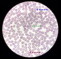 Blood film microscopic show decrease platelets leucocyte (WBC). Royalty Free Stock Photo