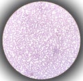 Blood film showing a decrease of platelets