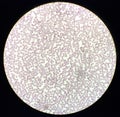 Blood film showing a decrease of platelets and White blood cells. Immune thrombocytopenic purpura (ITP)