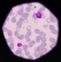 Blood films for Malaria parasite.show malaria pigment.