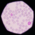 Blood films for Malaria parasite.show malaria pigment. Royalty Free Stock Photo