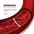 Blood high pressure vector medical infographic