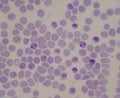 Blood parasite infected red blood cells Malaria Royalty Free Stock Photo