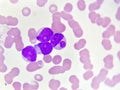 Acute myeloid leukemia