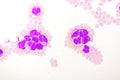 Blood picture of acute promyelocytic leukemia or APL