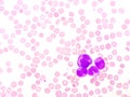 Blood picture of acute promyelocytic leukemia or APL