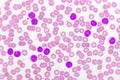 Blood picture of chronic lymphocytic leukemia or CLL Royalty Free Stock Photo