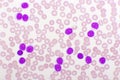 Blood picture of chronic lymphocytic leukemia or CLL Royalty Free Stock Photo