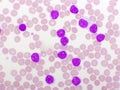 Blood picture of chronic lymphocytic leukemia