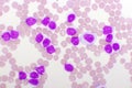 Blood picture of chronic lymphocytic leukemia