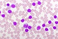 Blood picture of chronic lymphocytic leukemia