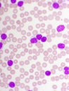 Blood picture of chronic lymphocytic leukemia or CLL Royalty Free Stock Photo