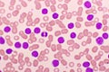 Blood picture of chronic lymphocytic leukemia or CLL Royalty Free Stock Photo