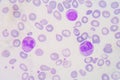 Blood smear Beta thalassemias (ÃÂ² thalassemias) are a group of