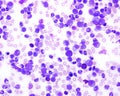 Blood smear. Chronic myeloid leukaemia