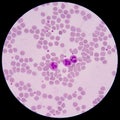 Blood smear form sepsis. Royalty Free Stock Photo