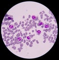 Blood smear form sepsis.