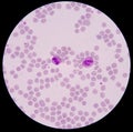 Blood smear form sepsis. Royalty Free Stock Photo