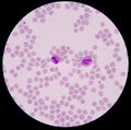 Blood smear form sepsis.