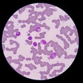 Blood smear form sepsis. Royalty Free Stock Photo